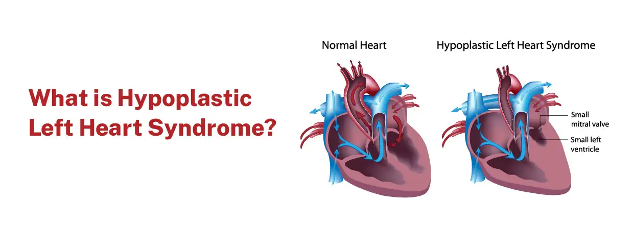 What is Hypoplastic Left Heart Syndrome?